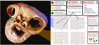 Automatic and interpretable prediction of the site of origin in outflow tract ventricular arrhythmias: machine learning integrating electrocardiograms and clinical data